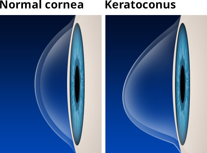 Keratoconus Symptoms and Treatment (Placentia, CA)