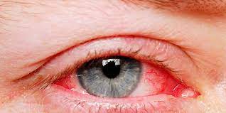 What is a Red Bloodshot Eye