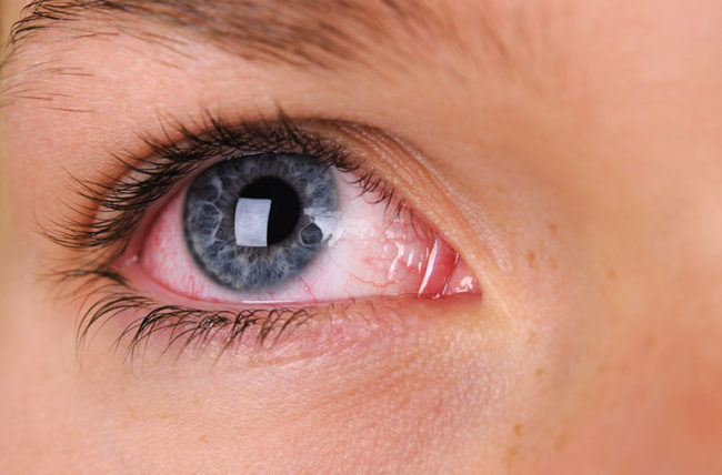 Remedies For Red Eyes (7 Simple Tips That Will Help)