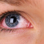 Remedies For Red Eyes (7 Simple Tips That Will Help)