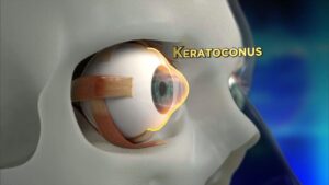 Keratoconus graphic of eye