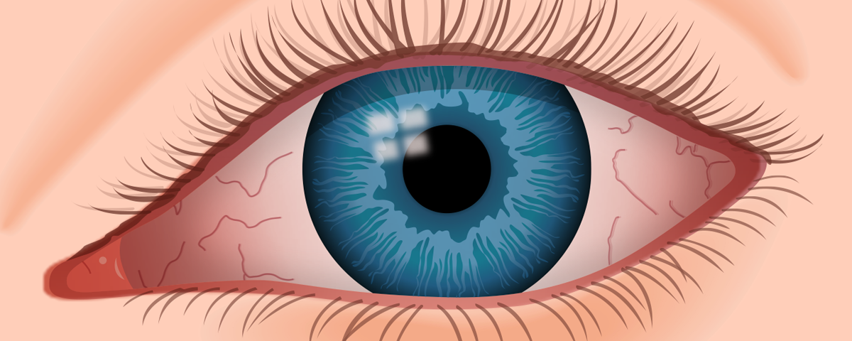 animated dry eye picture