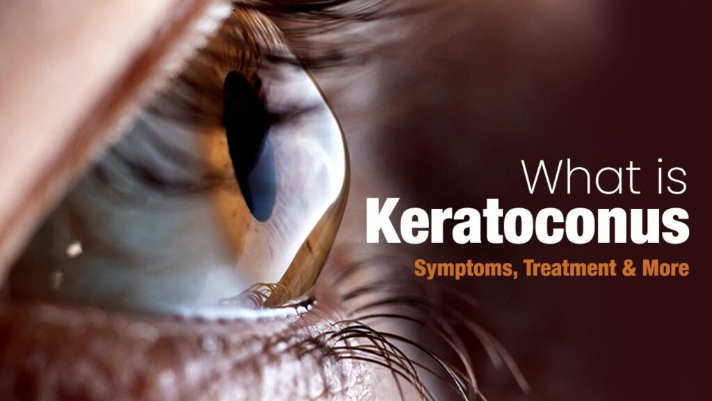 All About Keratoconus (Causes, Symptoms, And Treatments)