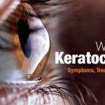 All About Keratoconus (Causes, Symptoms, And Treatments)