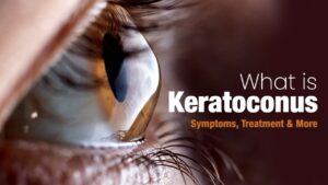 All About Keratoconus (Causes, Symptoms, And Treatments)