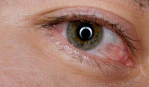 Close-up of an irritated eye with visible redness, commonly linked to fatigue, stress, or eye twitching episodes.