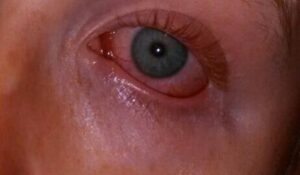 Is Waking Up With Red Eyes A Serious Health Problem?