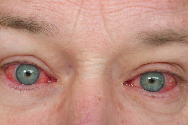a-close-up-of-a-man's-eye-with-a-red-spot-on-his-left