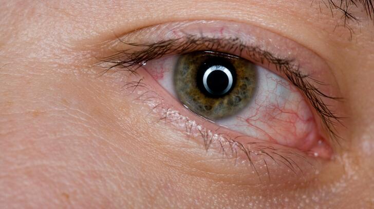 a close-up shot of an irritated eye