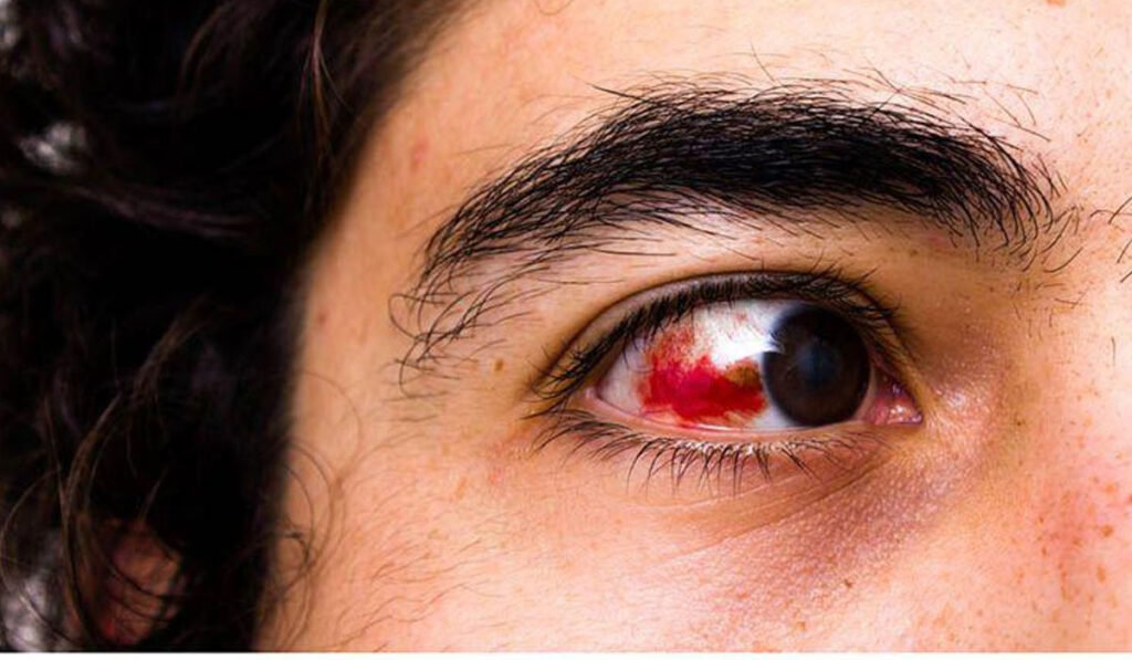 Understanding Red And Bloodshot Eyes: Causes, Symptoms And Treatments ...