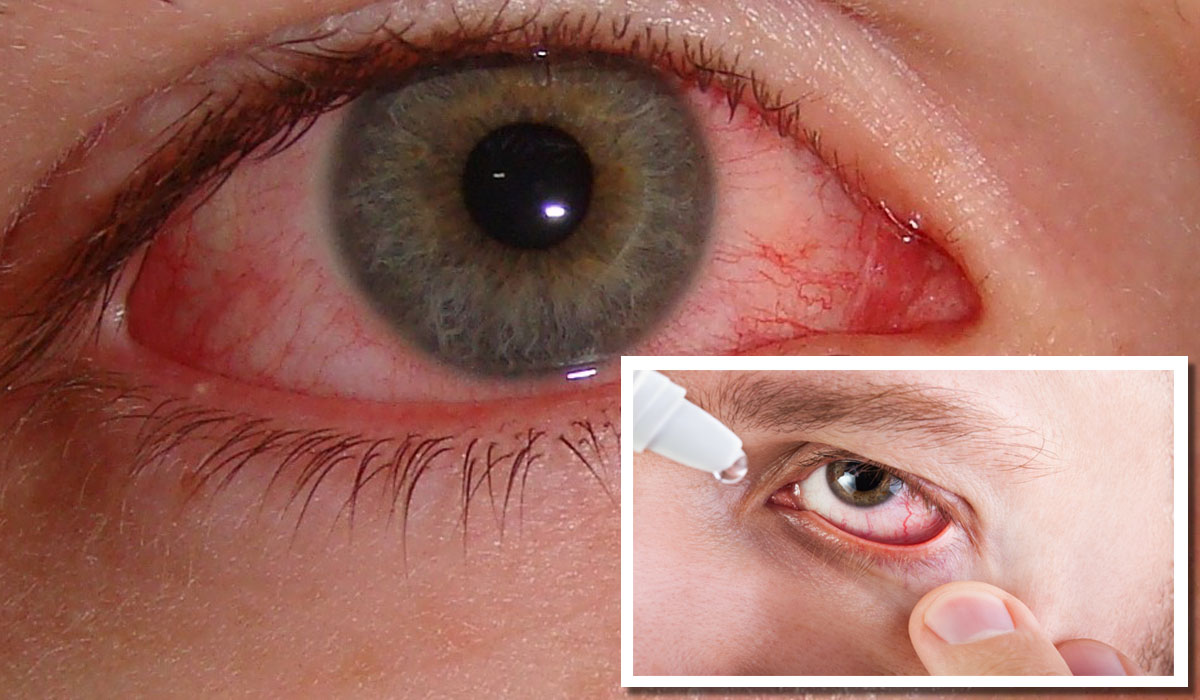 Close up shot of bloodshot and red eye