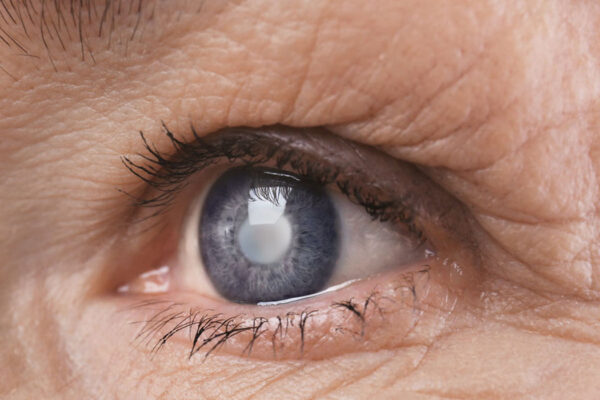 close-up shot of an eye with glaucoma