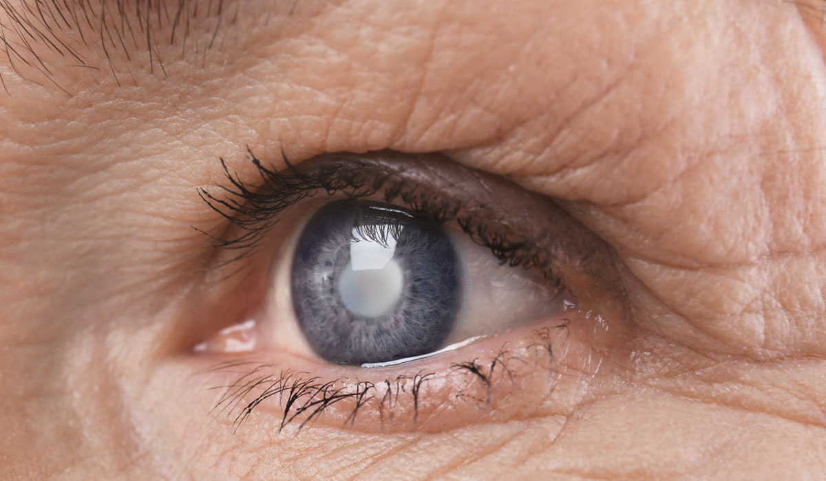 close-up shot of an eye with glaucoma