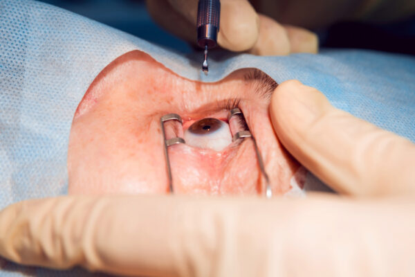 operation on the eye, cataract surgery