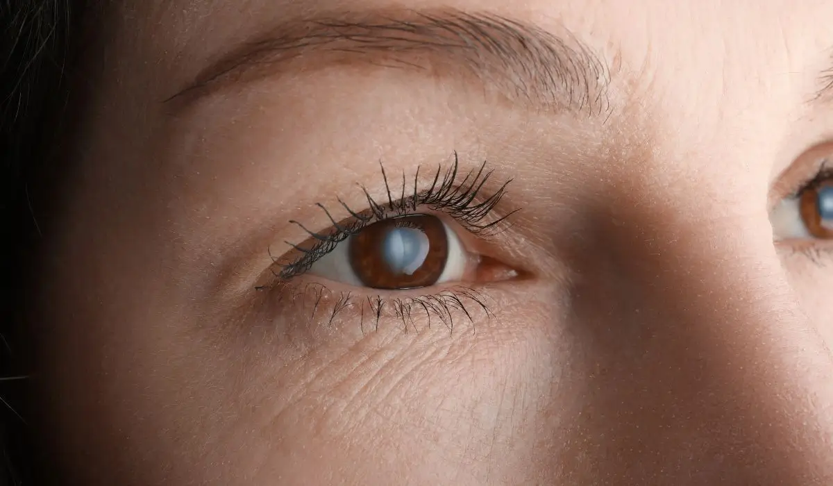 Close-up of an eye with visible signs of glaucoma disease, showing cloudy vision caused by optic nerve damage.