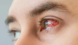 Close-up image showing a red spot on your eye, commonly linked to subconjunctival hemorrhage.