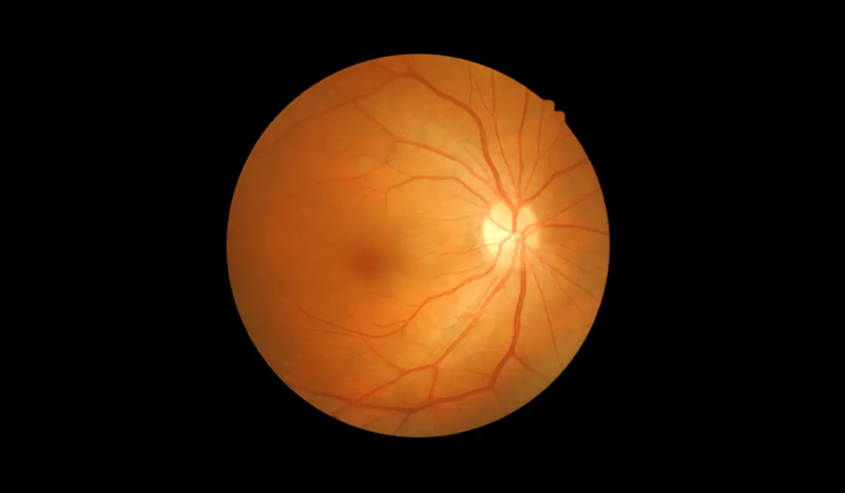 High-resolution retinal scan showing early signs of retinal detachment with visible optic nerve and vessels.