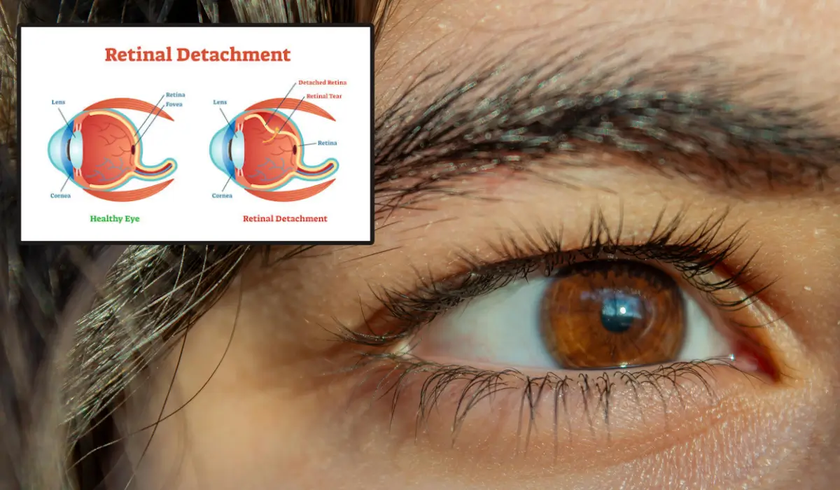 Close-up of a human eye with an overlaid medical diagram showing retinal detachment versus a healthy eye.