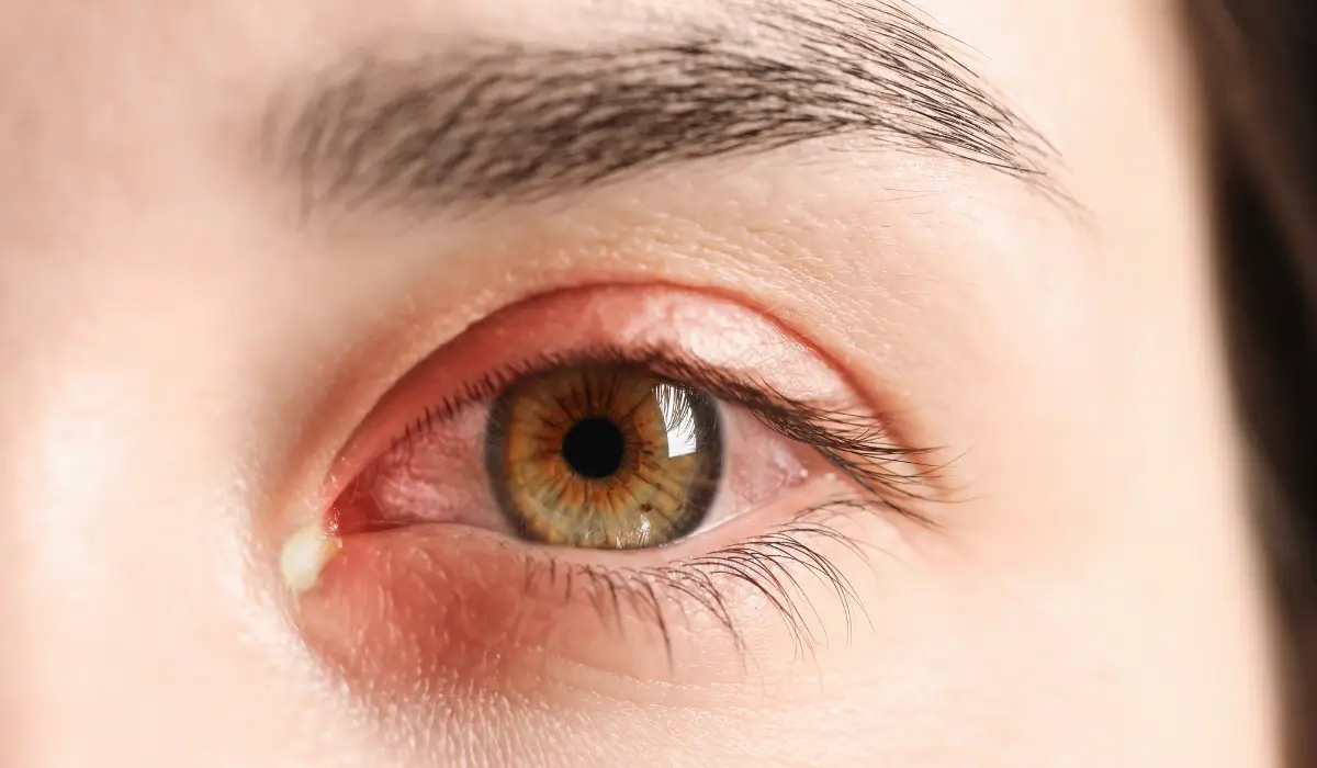 Close-up red irritated eye showing inflammation caused by spring allergies and allergic conjunctivitis symptoms.